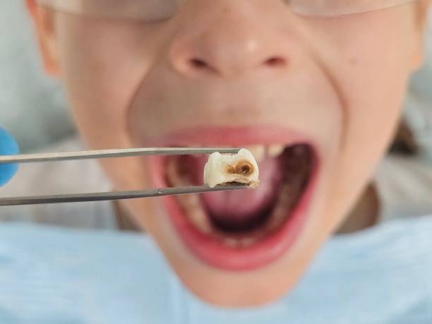 Best Emergency Broken Tooth Repair in Colville, WA